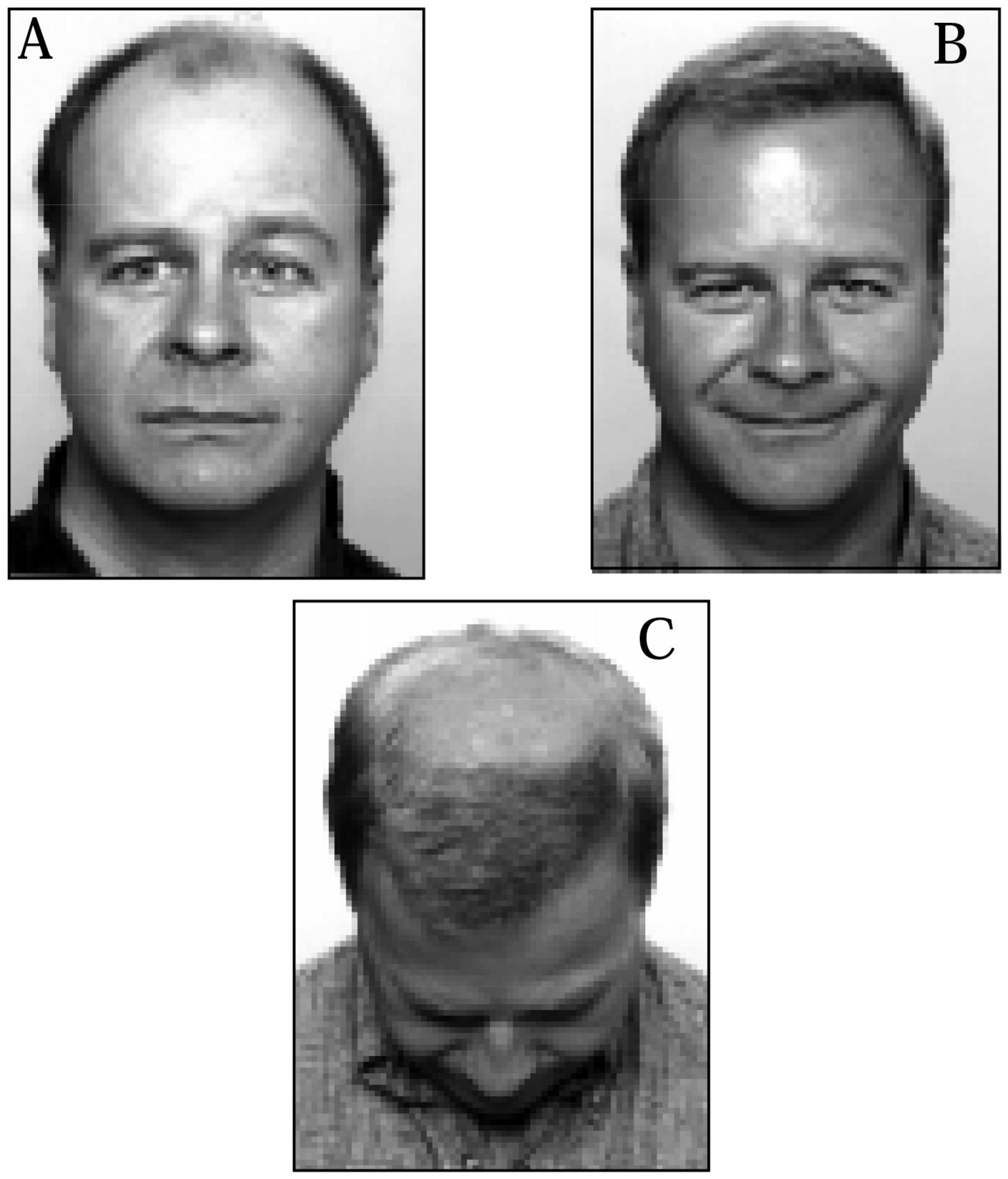 The “One-Pass Hair Transplant”—A Six-Year Perspective | Hair Transplant Forum International The “One-Pass Hair Transplant”—A Six-Year Perspective | Hair Transplant Forum International