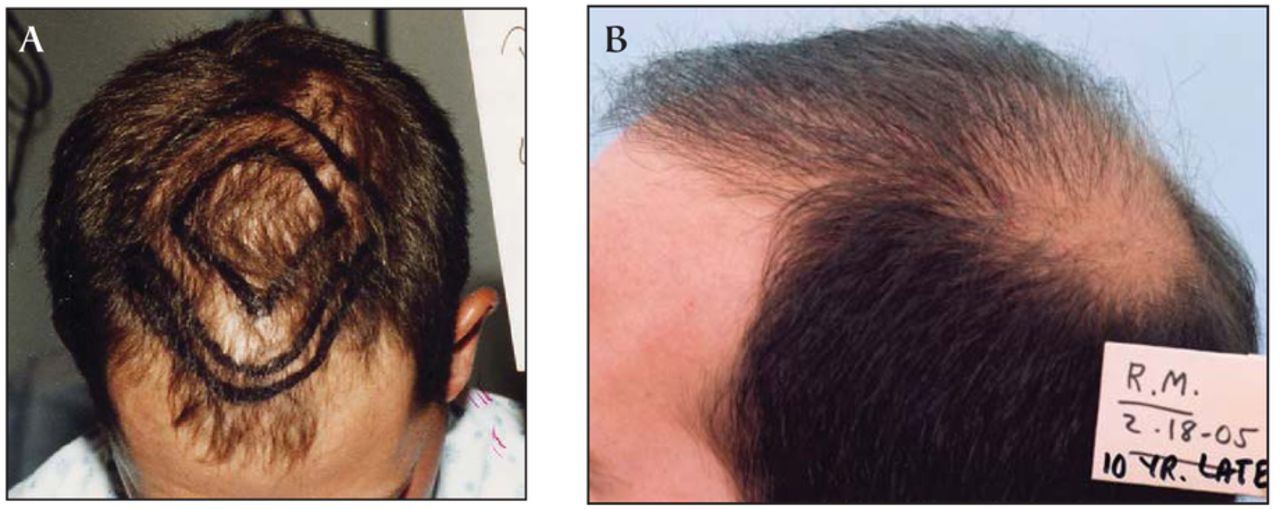 Update on Forelock Approach of Hair Transplantation | Hair Transplant Forum International Update on Forelock Approach of Hair Transplantation | Hair Transplant Forum International