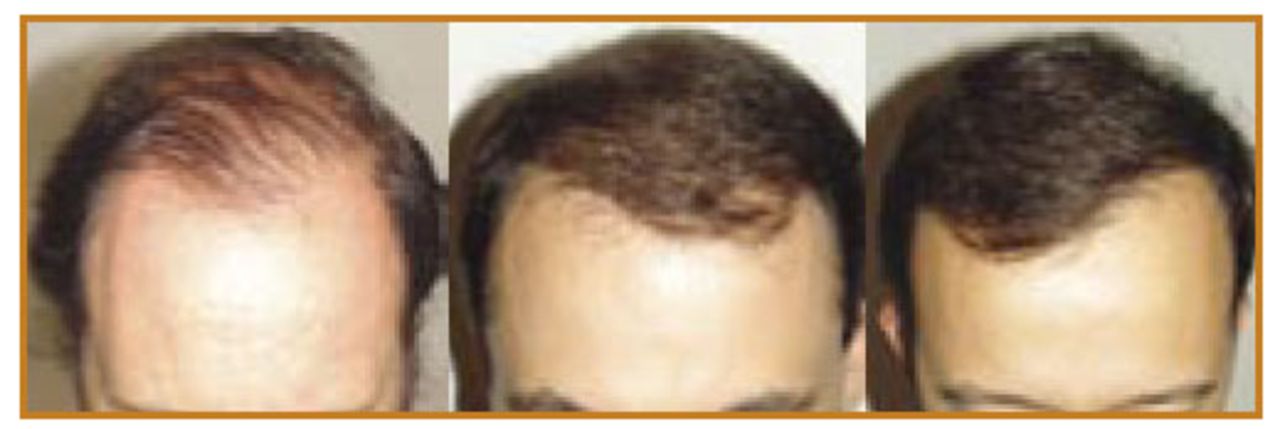 The consultation: expectations versus what can be offered in hair transplant surgery | Hair Transplant Forum International The consultation: expectations versus what can be offered in hair transplant surgery | Hair Transplant Forum International