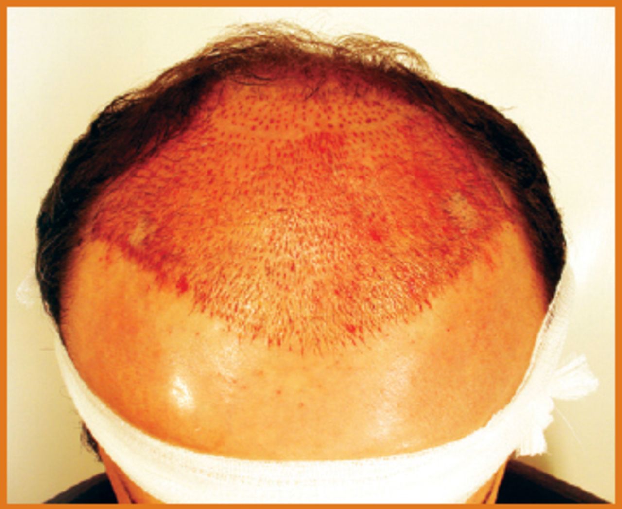 To divide or not to divide, this is the question | Hair Transplant Forum International To divide or not to divide, this is the question | Hair Transplant Forum International