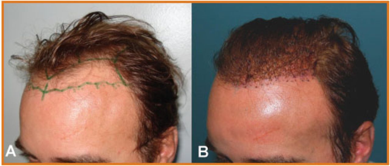 FUE Technique Hair Transplant in Men  Caribbean Hair Transplant Centre