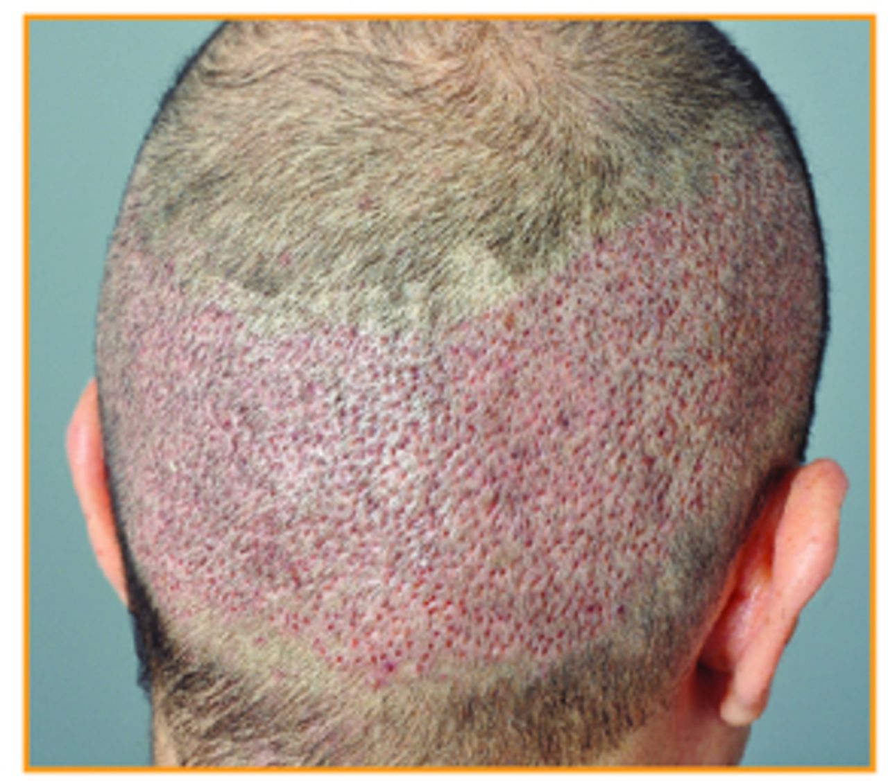 How I Do It: Untouched strip: FUE combined with strip surgery to improve the FU number harvested in one session, preserving an untouched area for a possible future transplant | Hair Transplant How I Do It: Untouched strip: FUE combined with strip surgery to improve the FU number harvested in one session, preserving an untouched area for a possible future transplant | Hair Transplant