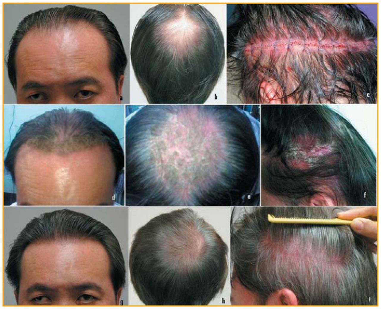 Best Methods to Treat Scalp Psoriasis Induced Hair Loss