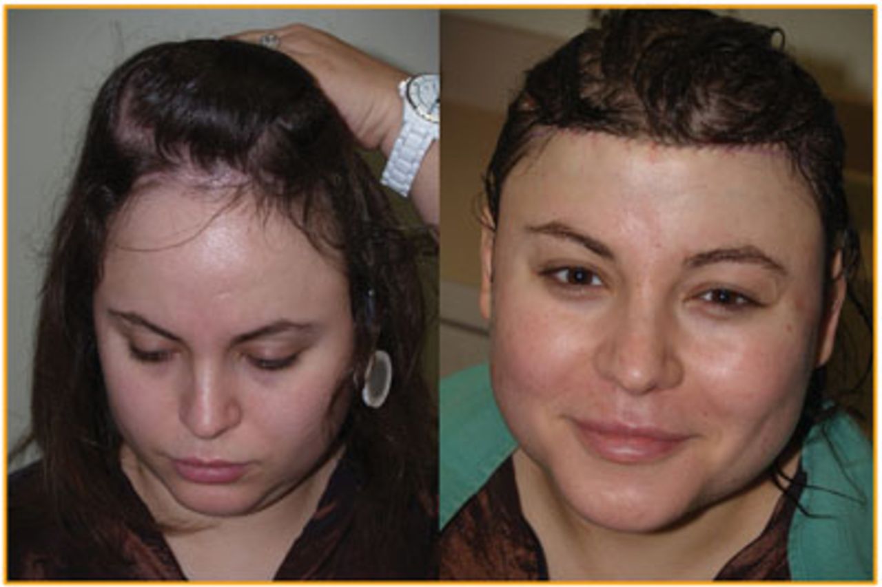 Hairline Lowering vs Hair Transplantation  Plastic Surgeon Beverly Hills  CA  Dr Jason Champagne