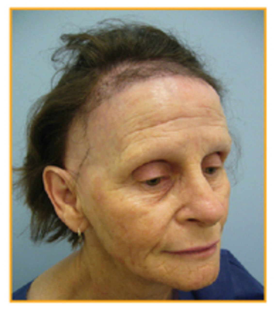 Causes and Treatment of Frontal Fibrosing Alopecia FFA