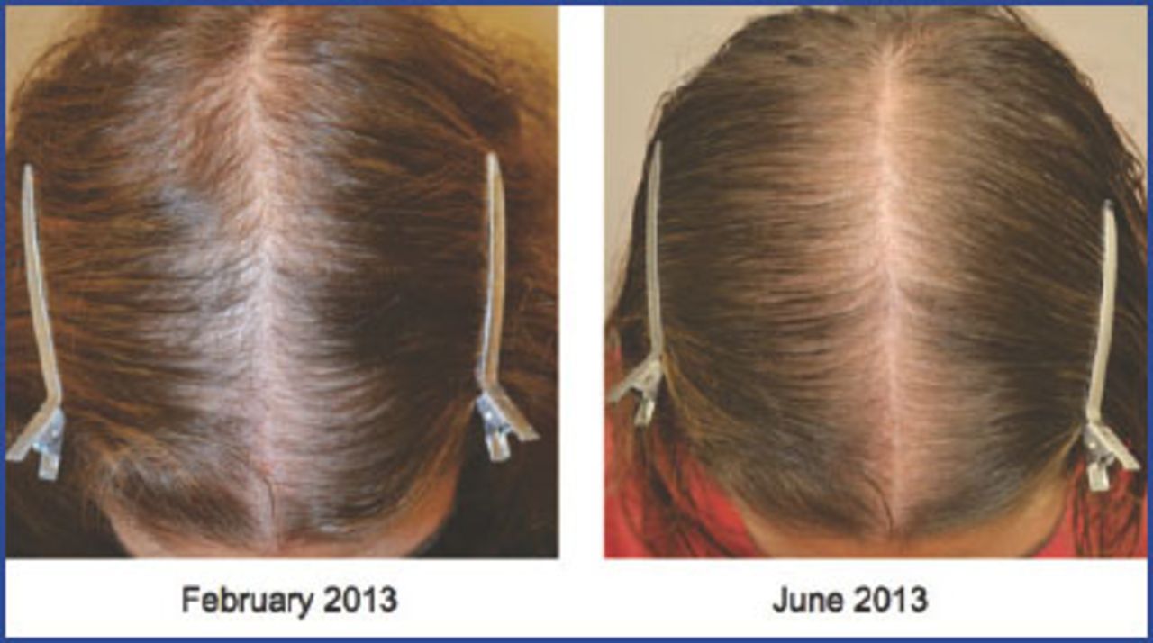 Female Pattern Hair loss - Aglow Dermatology