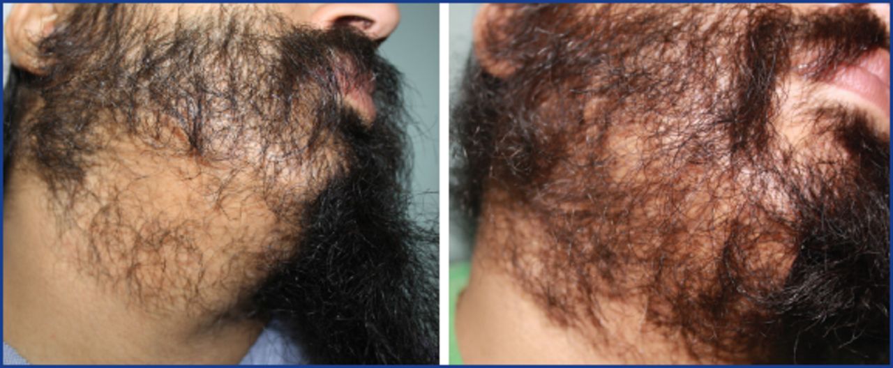 Facial Hair Transplantation | Hair Transplant Forum International Facial Hair Transplantation | Hair Transplant Forum International