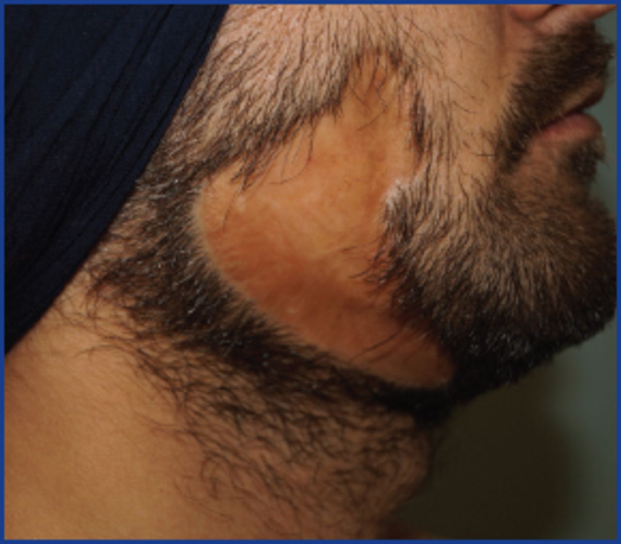 Facial Hair Transplantation | Hair Transplant Forum International Facial Hair Transplantation | Hair Transplant Forum International