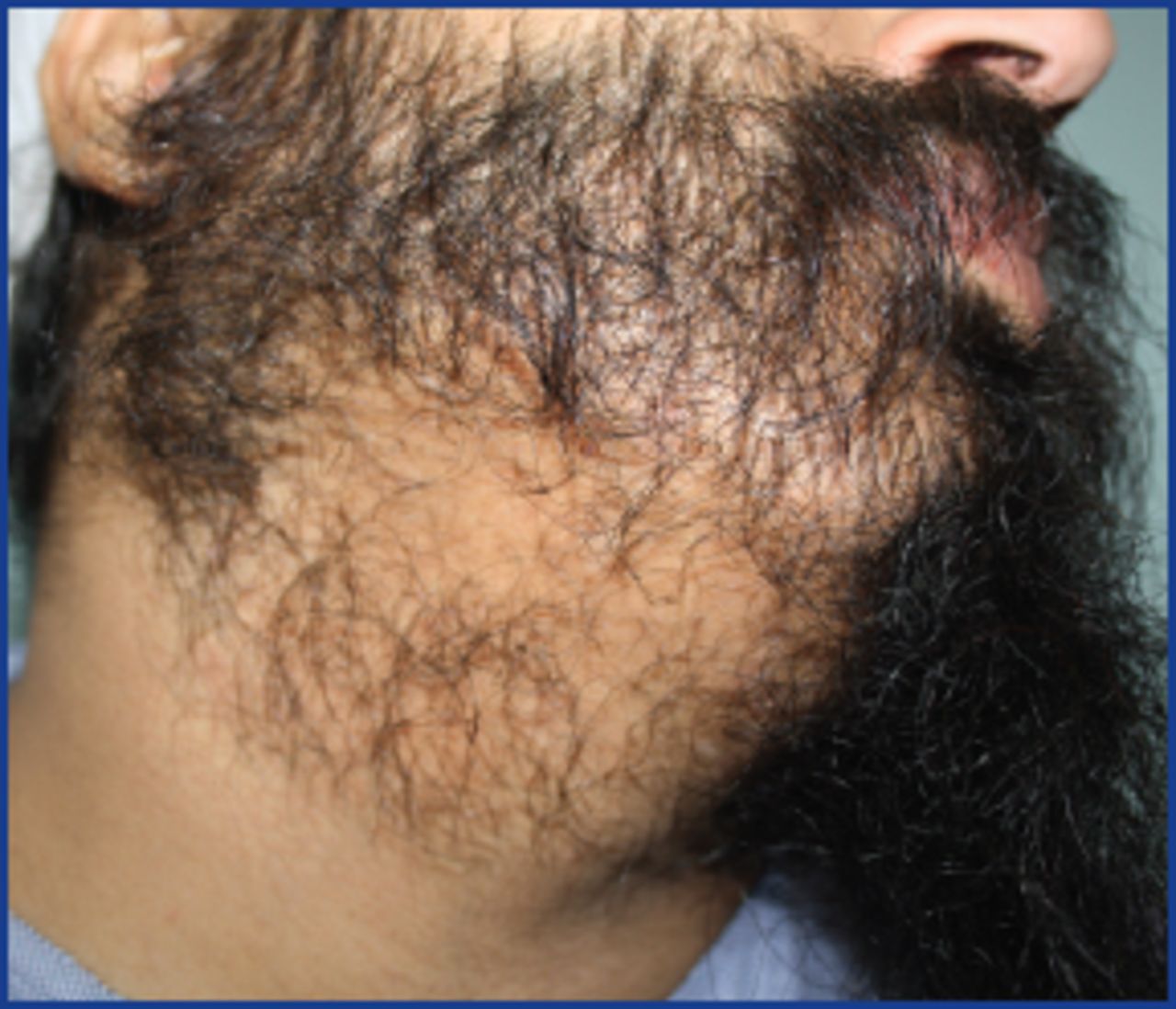 Facial Hair Transplantation | Hair Transplant Forum International Facial Hair Transplantation | Hair Transplant Forum International