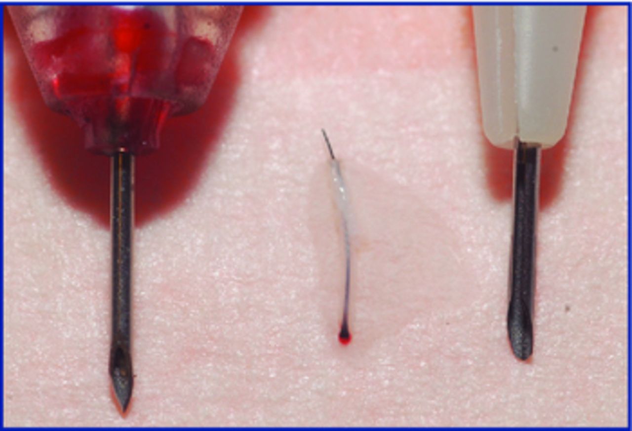 FUE Graft Placement with Dull Needle Implanters into Premade Sites | Hair Transplant Forum International FUE Graft Placement with Dull Needle Implanters into Premade Sites | Hair Transplant Forum International