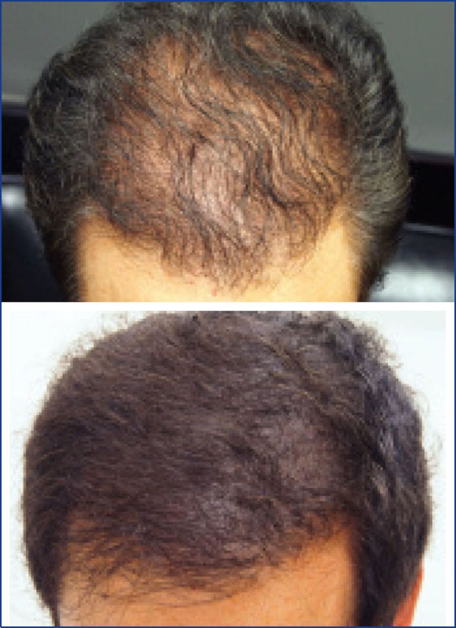 FUE Transplant Los Angeles - LA FUE Hair Clinic – Los Angeles FUE Hair  Transplant Clinic