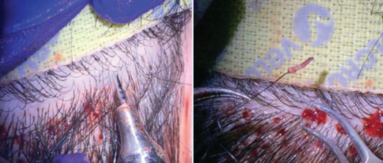 Type of FUE hair transplant technique