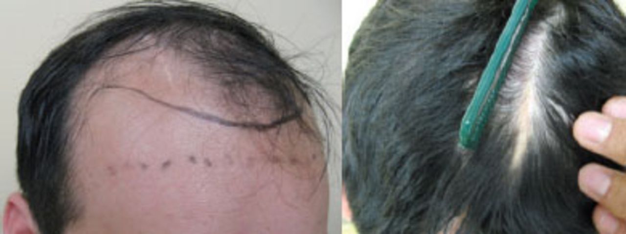 Hair Restoration in Cranial Surgery Patients | Hair Transplant Forum International Hair Restoration in Cranial Surgery Patients | Hair Transplant Forum International