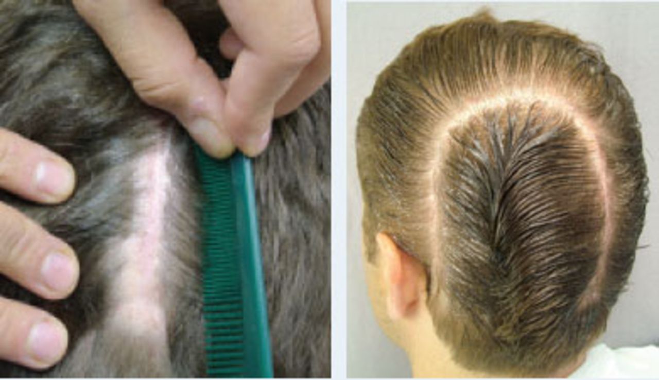 Hair Restoration in Cranial Surgery Patients | Hair Transplant Forum International Hair Restoration in Cranial Surgery Patients | Hair Transplant Forum International
