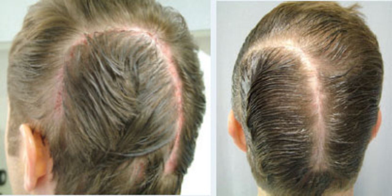 Hair Restoration in Cranial Surgery Patients | Hair Transplant Forum International Hair Restoration in Cranial Surgery Patients | Hair Transplant Forum International