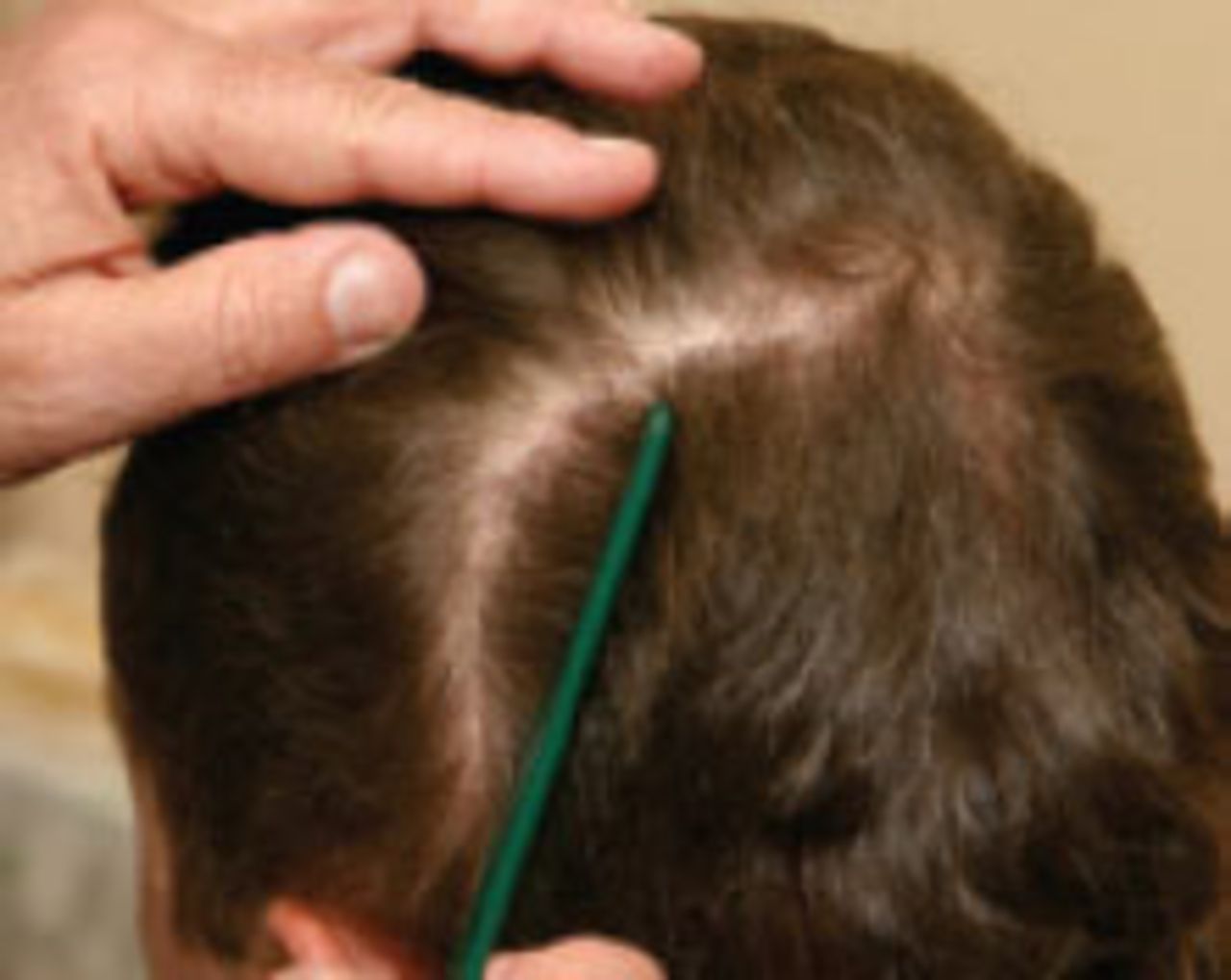 Hair Restoration in Cranial Surgery Patients | Hair Transplant Forum International Hair Restoration in Cranial Surgery Patients | Hair Transplant Forum International