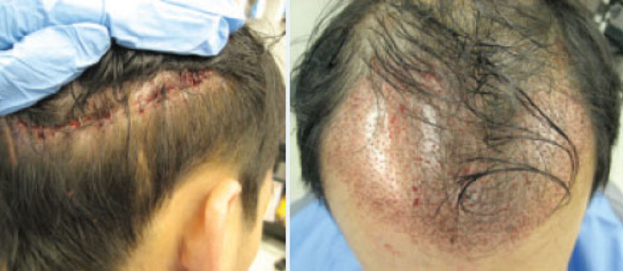 Hair Restoration in Cranial Surgery Patients | Hair Transplant Forum International Hair Restoration in Cranial Surgery Patients | Hair Transplant Forum International