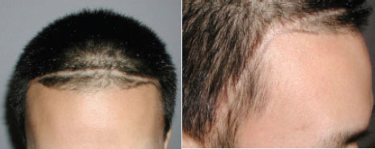 Hair Restoration in Cranial Surgery Patients | Hair Transplant Forum International Hair Restoration in Cranial Surgery Patients | Hair Transplant Forum International
