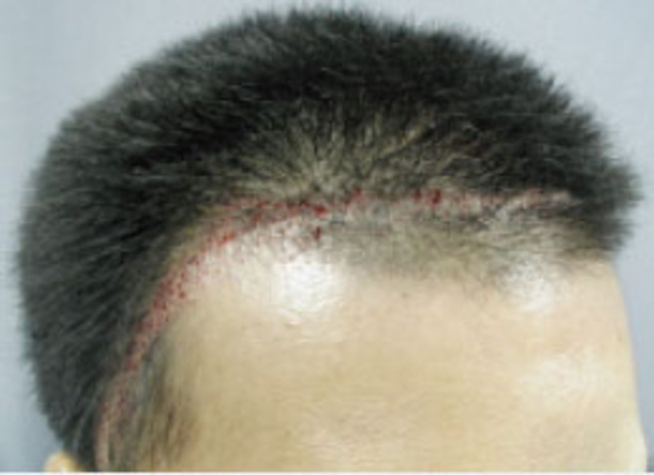 Hair Restoration in Cranial Surgery Patients | Hair Transplant Forum International Hair Restoration in Cranial Surgery Patients | Hair Transplant Forum International