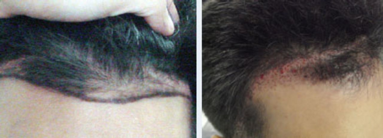 Hair Restoration in Cranial Surgery Patients | Hair Transplant Forum International Hair Restoration in Cranial Surgery Patients | Hair Transplant Forum International