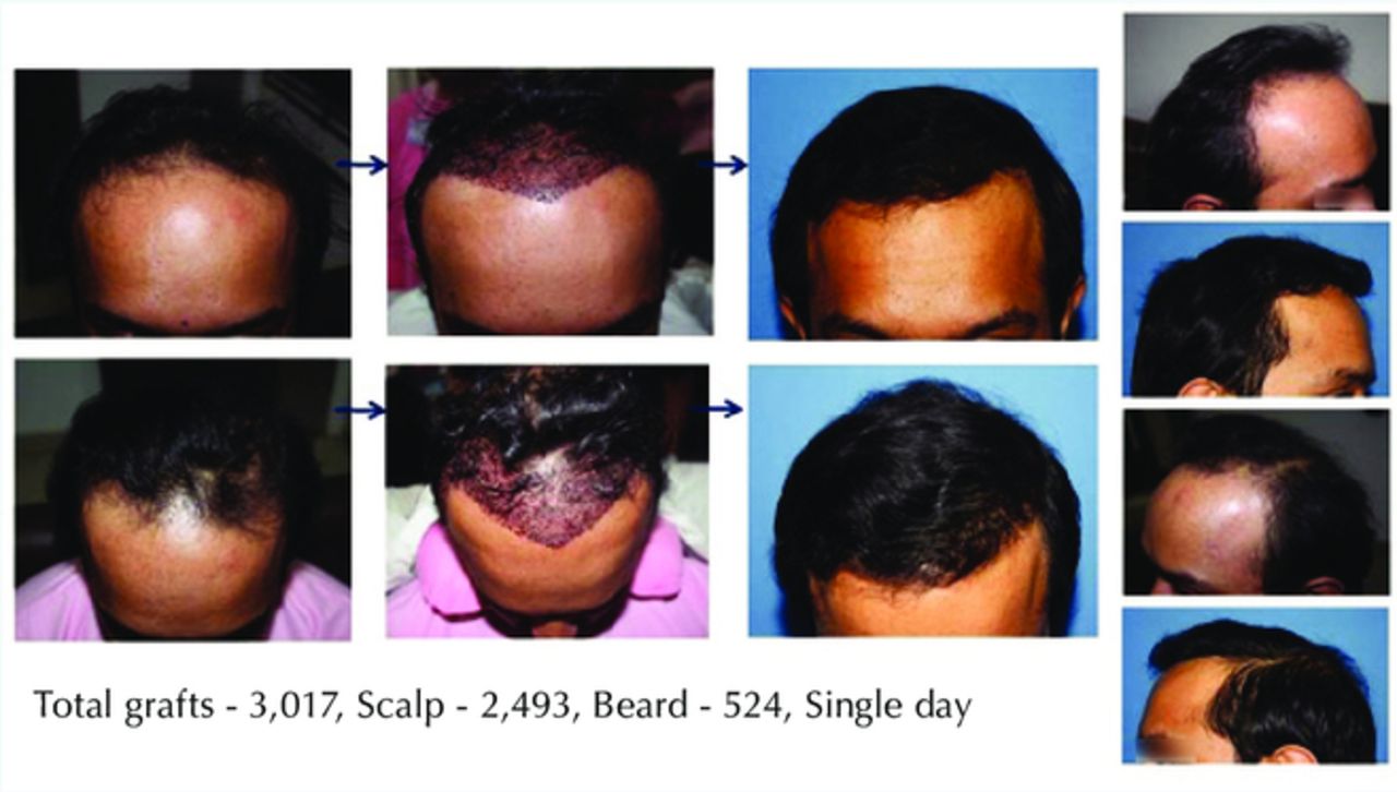The Use of Body Hair with Scalp Hair for “Combination Grafting” to Enhance Visual Density of Hair Transplantation and Increase Coverage in Advanced Alopecia | Hair Transplant Forum International The Use of Body Hair with Scalp Hair for “Combination Grafting” to Enhance Visual Density of Hair Transplantation and Increase Coverage in Advanced Alopecia | Hair Transplant Forum International