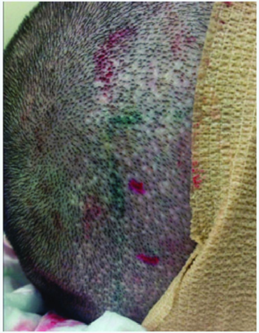 FUE Hair Transplant Trypophobia Fear Of Holes On The Scalp