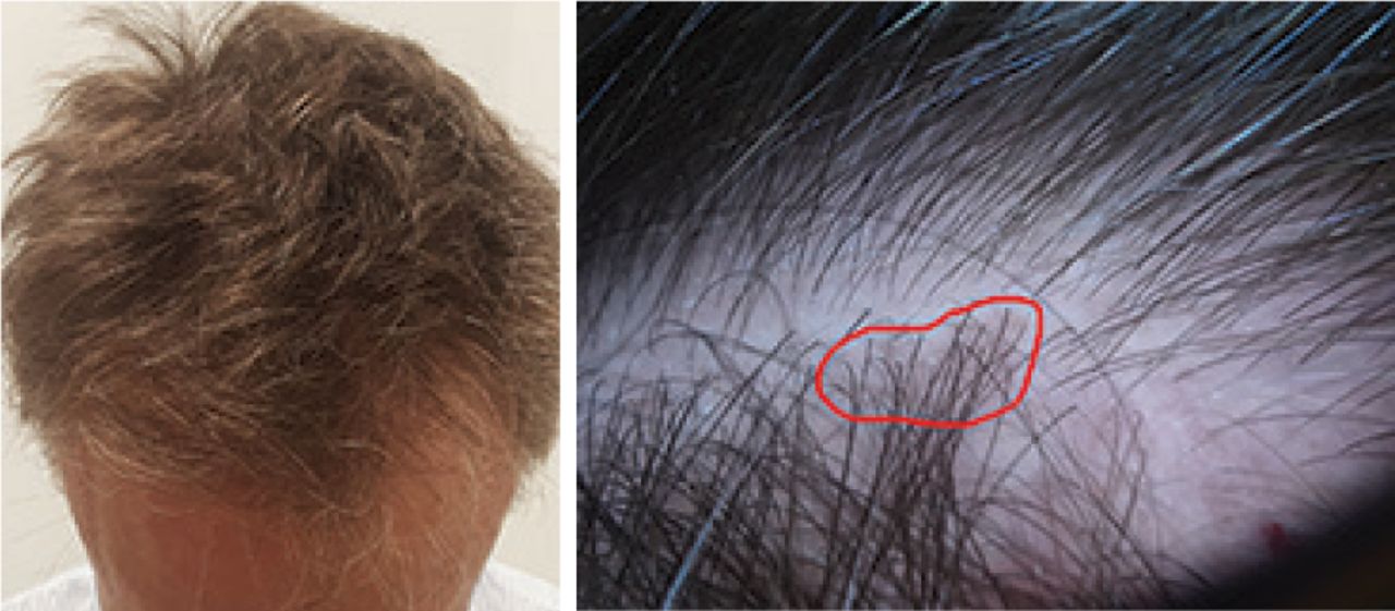 Lichen Planopilaris Mimicking Androgenic Alopecia: The Importance of Using a Dermatoscope | Hair Transplant Forum International Lichen Planopilaris Mimicking Androgenic Alopecia: The Importance of Using a Dermatoscope | Hair Transplant Forum International