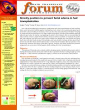 International Society of Hair Restoration Surgery: 19 (3)